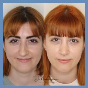 Schiefe Nasenscheidewand: Symptome erkennen und richtig behandeln