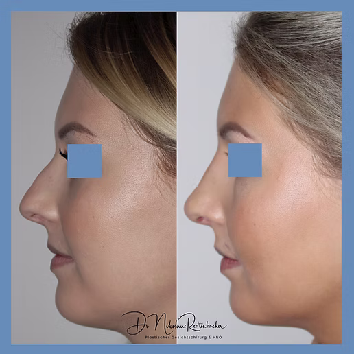 Nasenkorrekturohneop