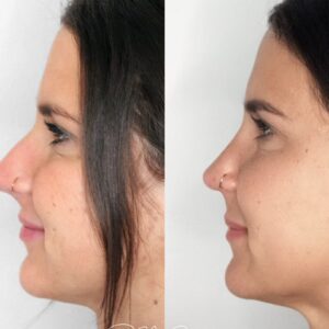 Nasenkorrektur was ist möglich