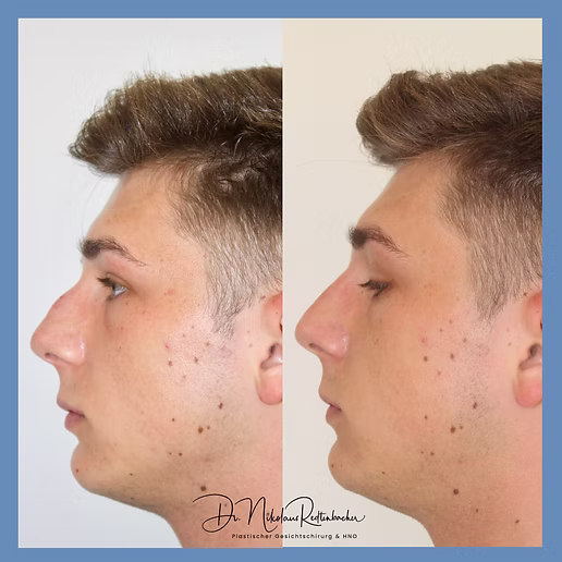 nasenkorrekturohneoperation