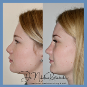 Nasenhöcker entfernen - Dr. N. Redtenbacher