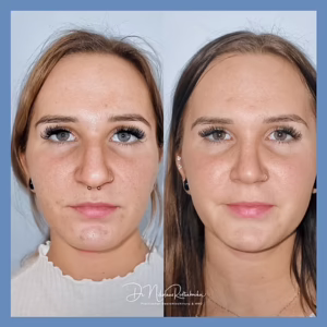 An der Nase abnehmen - img.2