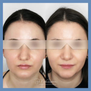 An der Nase abnehmen